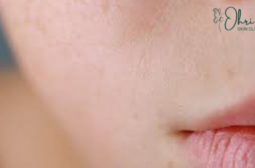 Why Your Skin Stays Dehydrated Even After Moisturizing