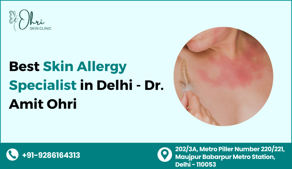 Best Skin Allergy Specialist in Delhi | Dr. Amit Ohri