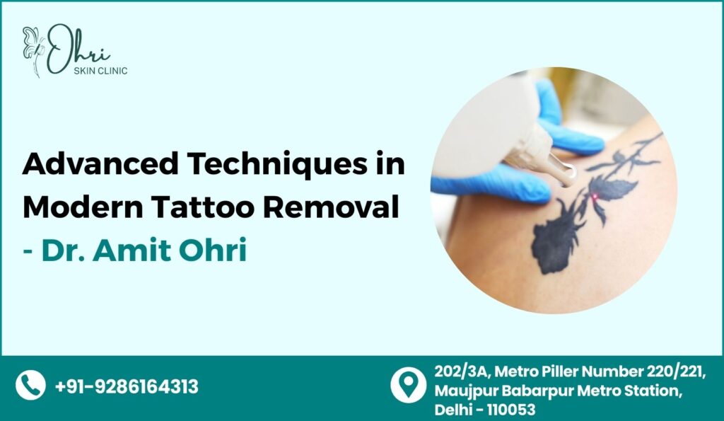tattoo removal in delhi