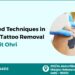 tattoo removal in delhi