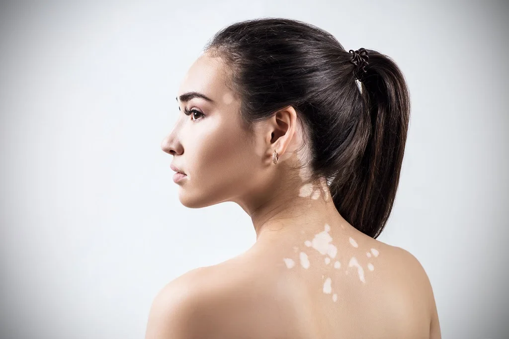 White Spot (Vitiligo) Treatment in Delhi